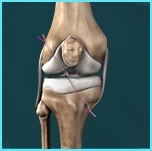 acl-reconstruction