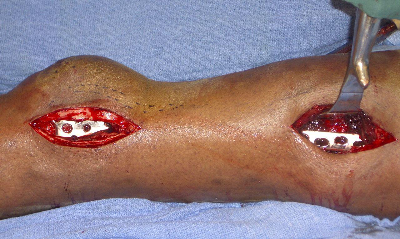 blog-minimally-invasive-surgery-in-orthopaedic-trauma