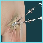 Hip arthroscopy